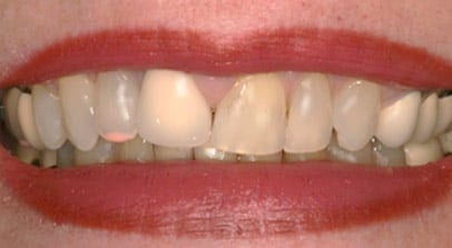 before lengthen veneers