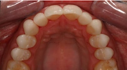 Tom after porcelain veneers