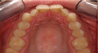 Tom before porcelain veneers