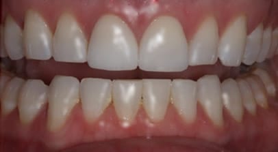 after porcelain veneers