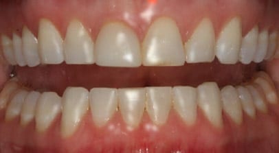veneers unsure before