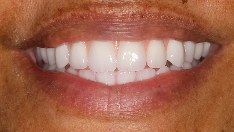 TIADPatient21Smile_After