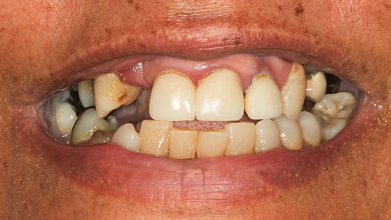 TIADPatient21Smile_Before