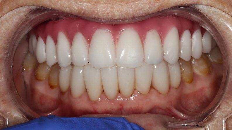 TIADPatient22_After