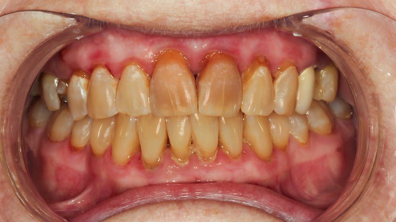 TIADPatient22_Before