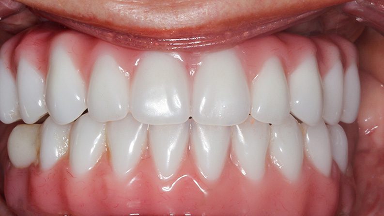 TIADPatient24_After