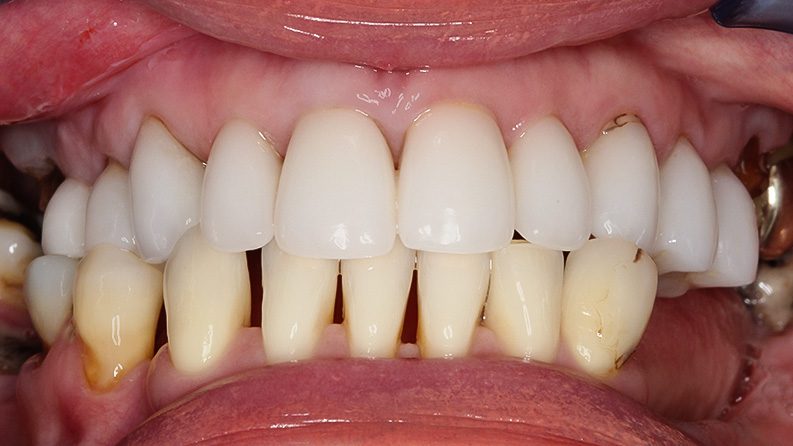 TIADPatient24_Before