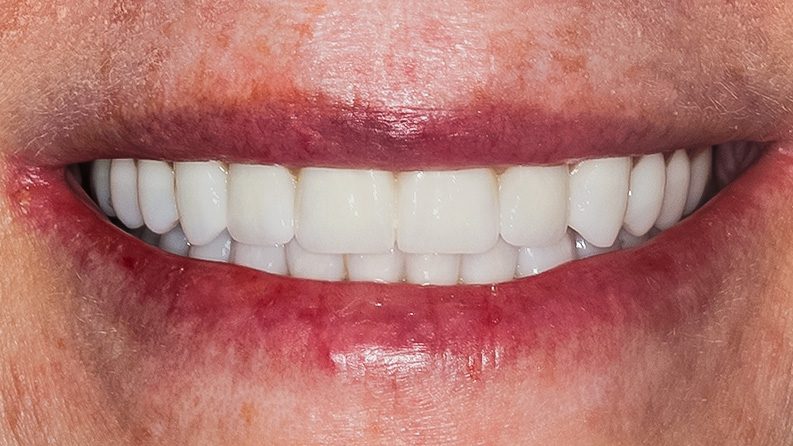 TIADPatient25_After