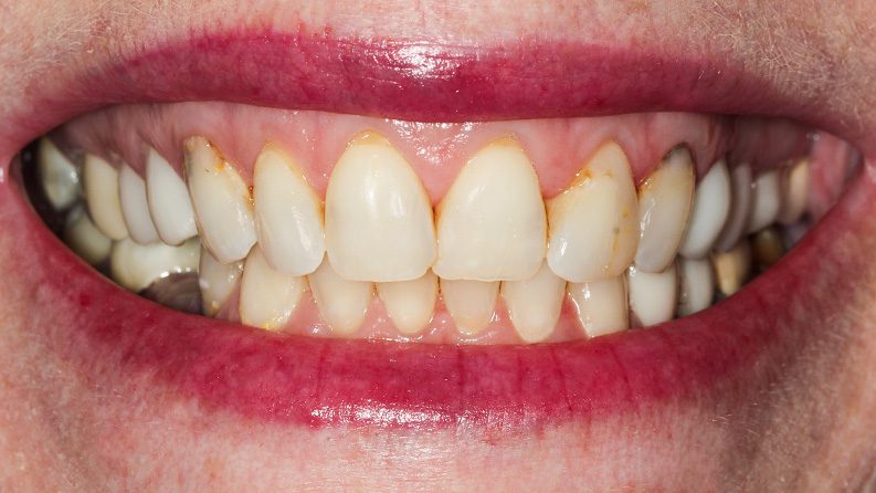 TIADPatient25_Before