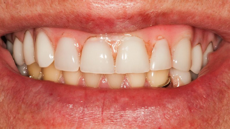 TIADPatient26_After