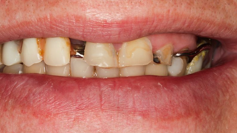 TIADPatient26_Before