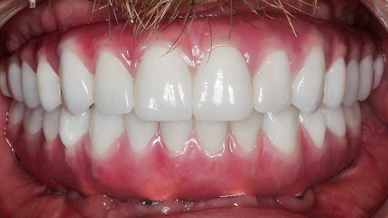 TIADPatient27_After