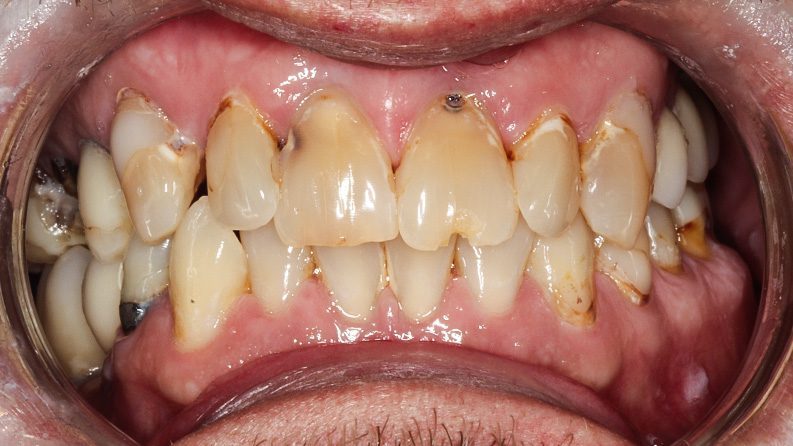 TIADPatient27_Before