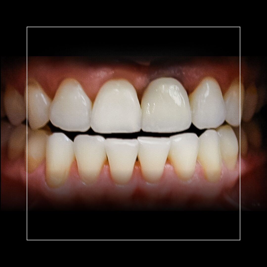 Anterior Implant – Restoring a Natural-Looking Smile