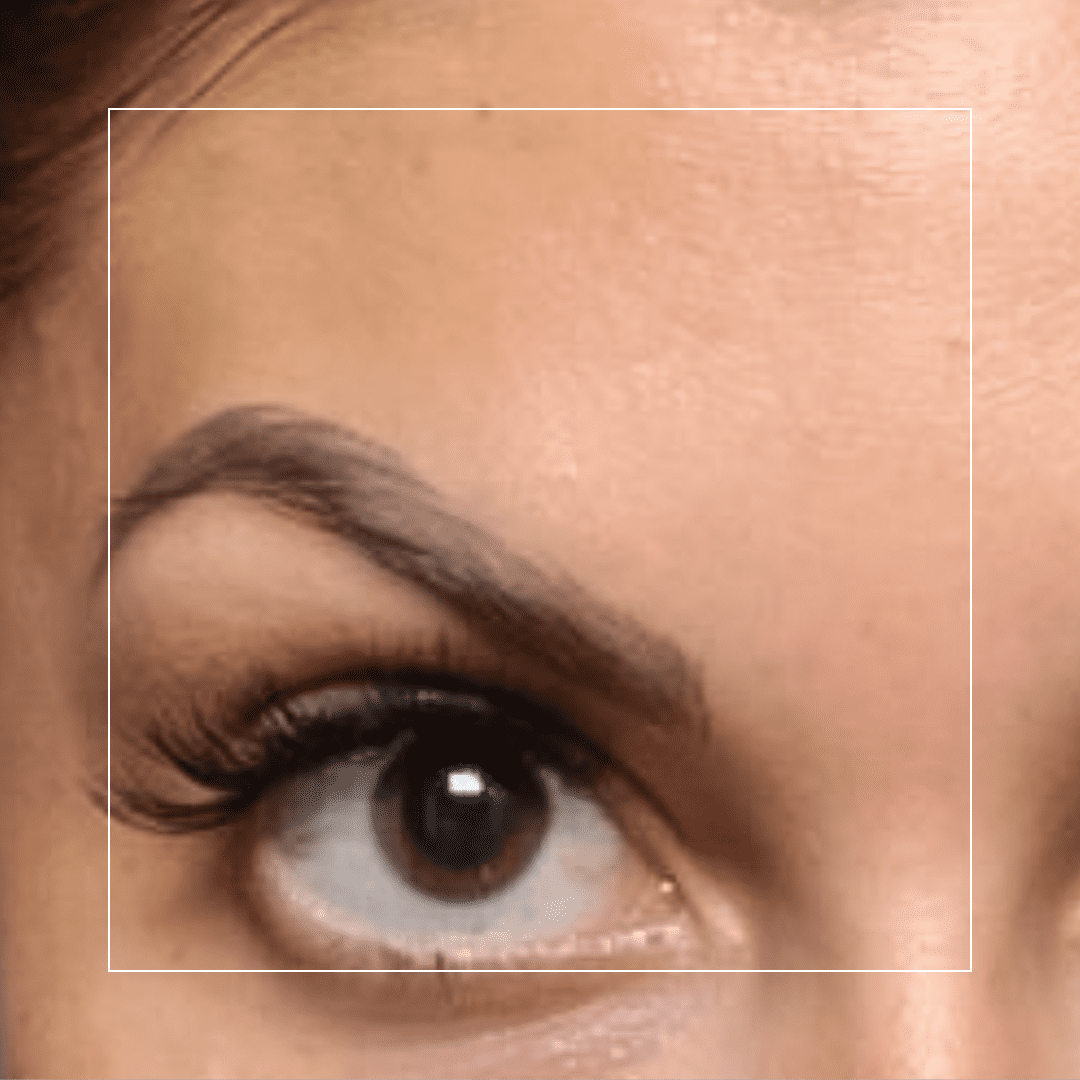 Botox – Angelia