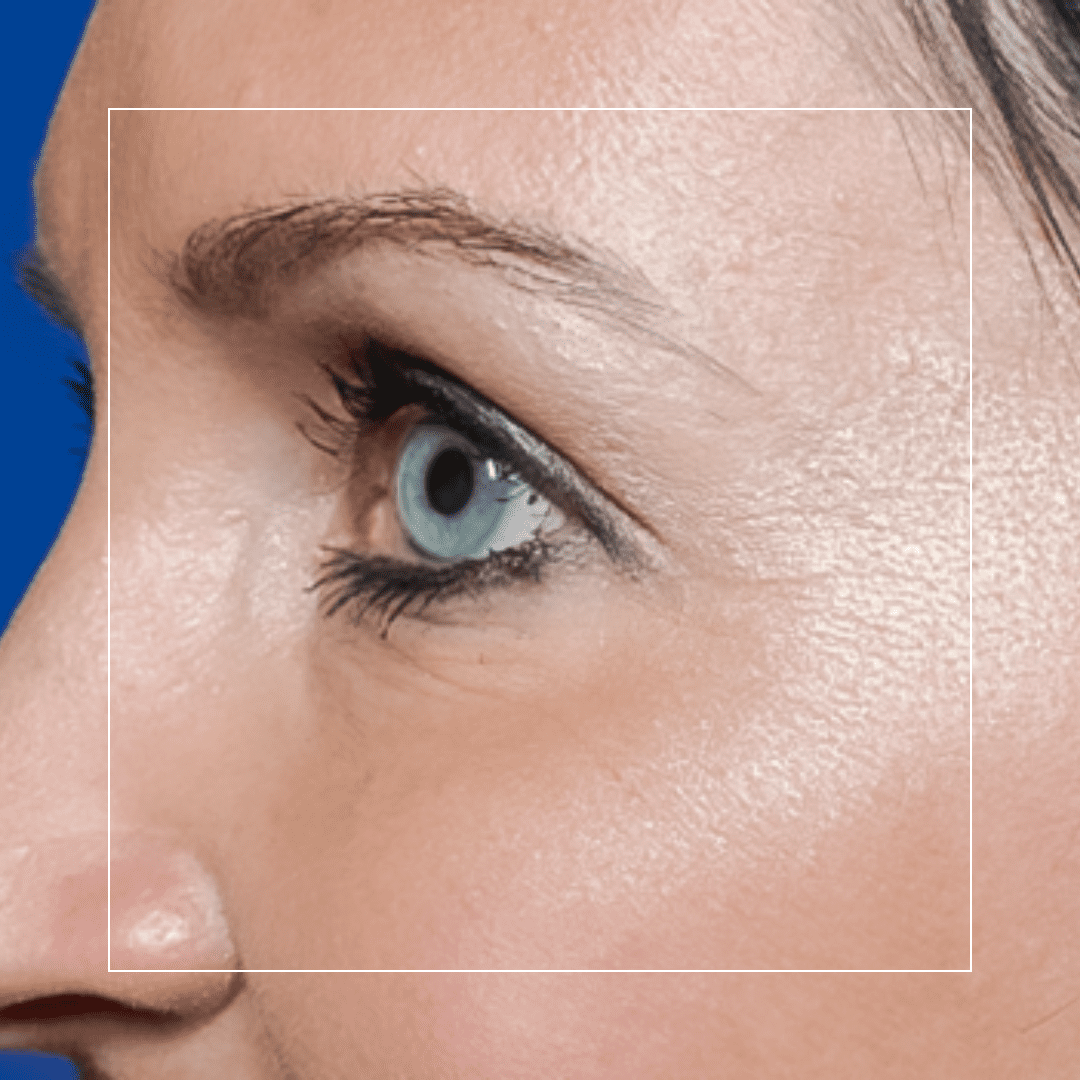 Botox – Melissa