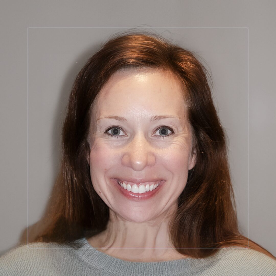 Callie – Enhancing Anterior Aesthetics with Custom Crowns