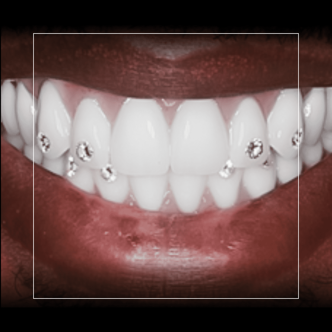 Cedric – Full Mouth Rehabilitation with TIAD _All on 6