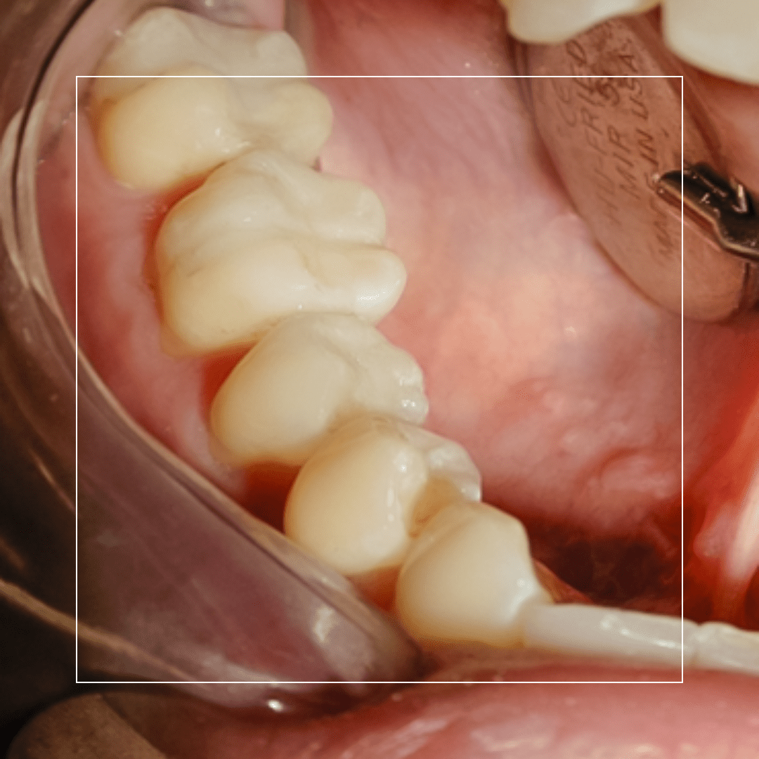 Composite Fillings