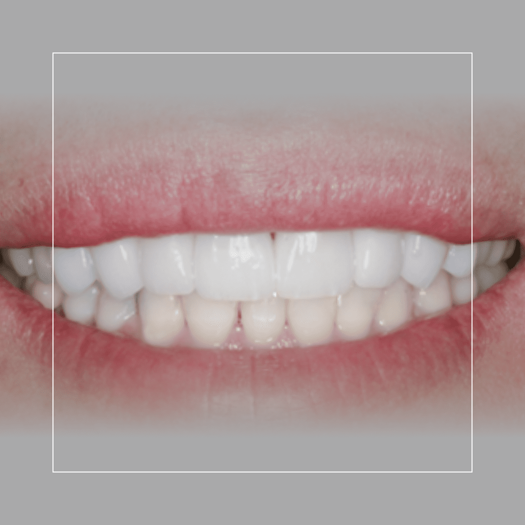 Eight Upper Veneers for Discolored Front Teeth