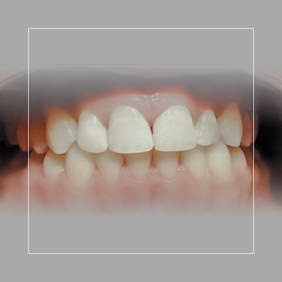 Fluorosis Treatment