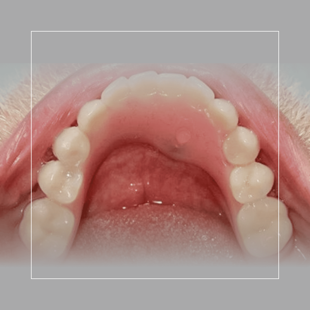 Lower Implant Hybrid Denture – Stability & Function