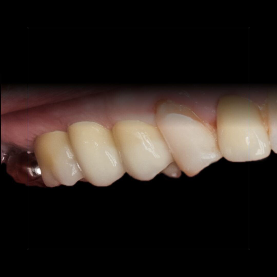 Multiple Posterior Implants – Restoring Strength and Stability