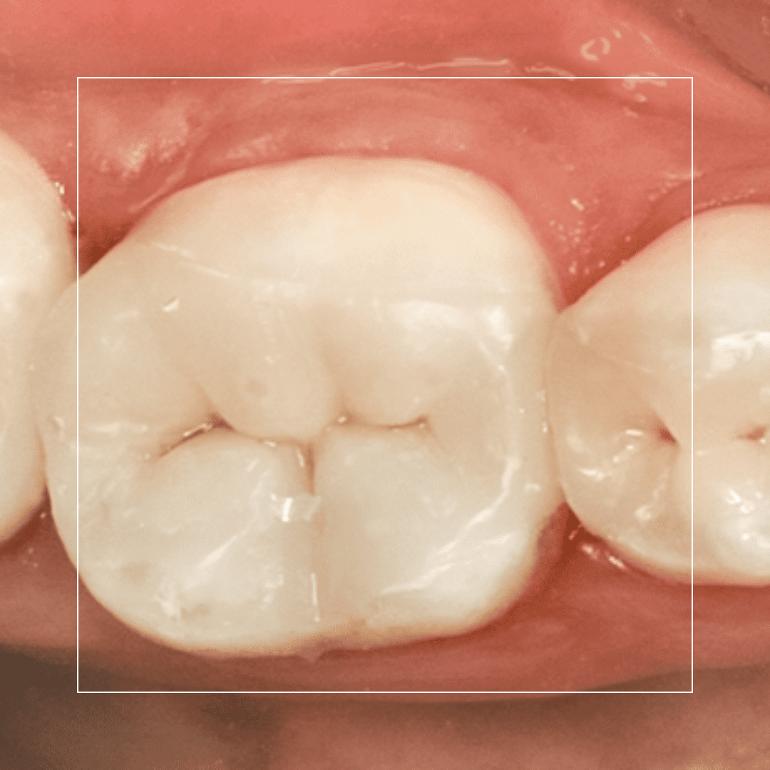 Silver Fillings and Onlays