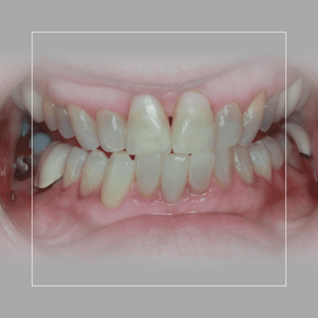 Single Lower Veneer to Straighten – A Small Change with a Big Impact