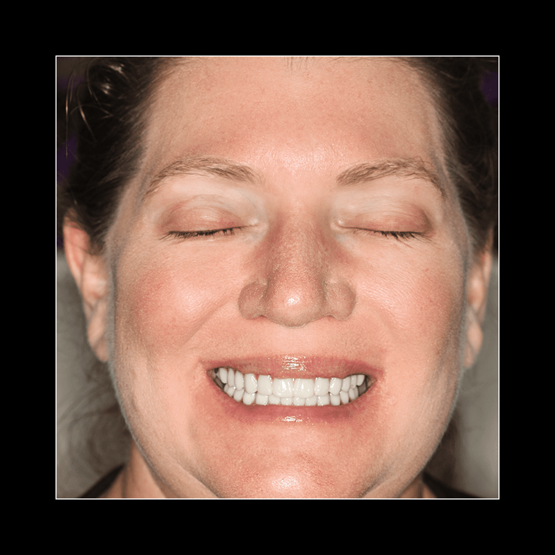 Teeth in a Day – Amy
