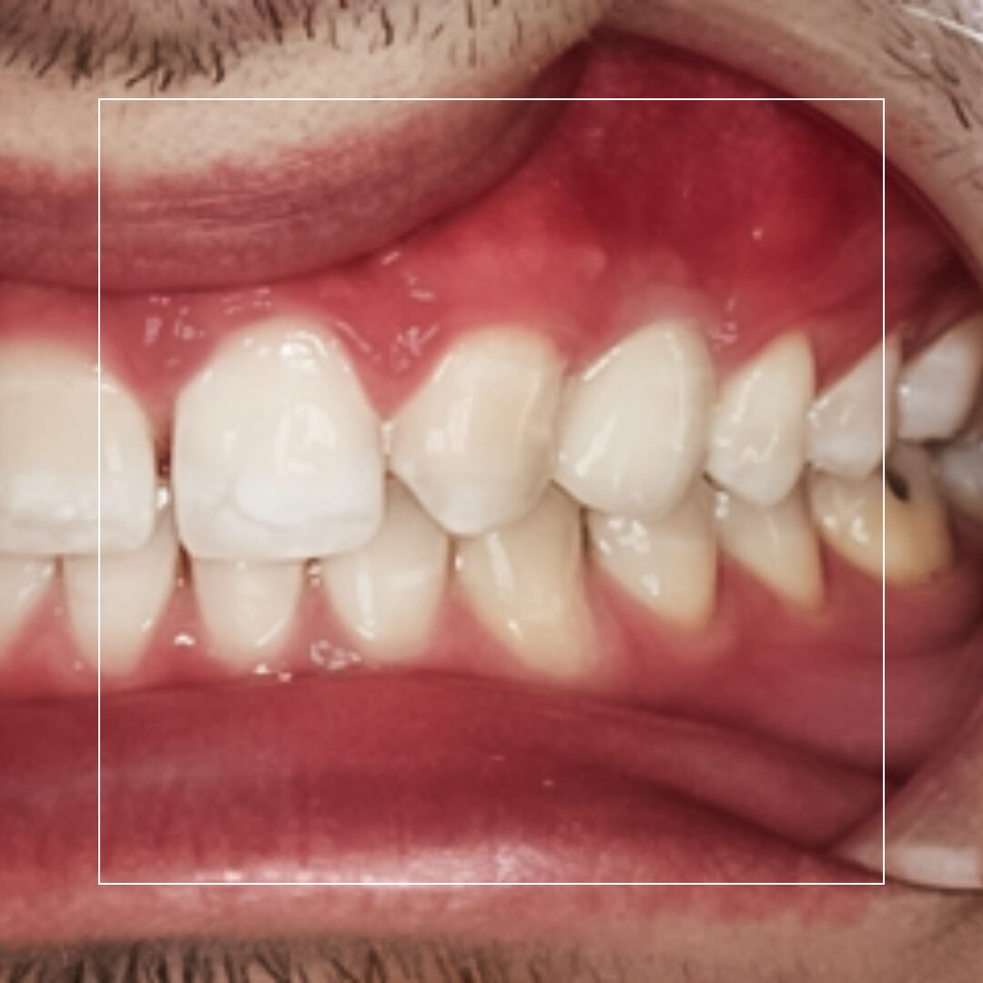 Tooth #11 Implant with Zirconia Abutment – Aesthetic & Durable Solution