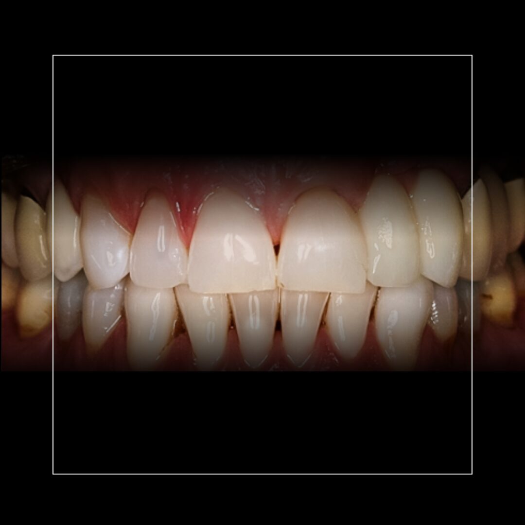 Tooth #5 Implant & Tooth #11 Cantilever – Customized Approach for Stability
