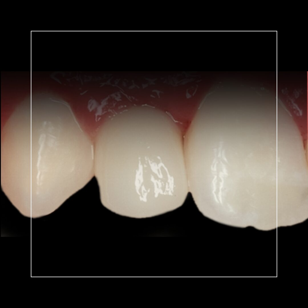 Tooth #7 Implant with Gold Abutment (2) – Strength & Longevity