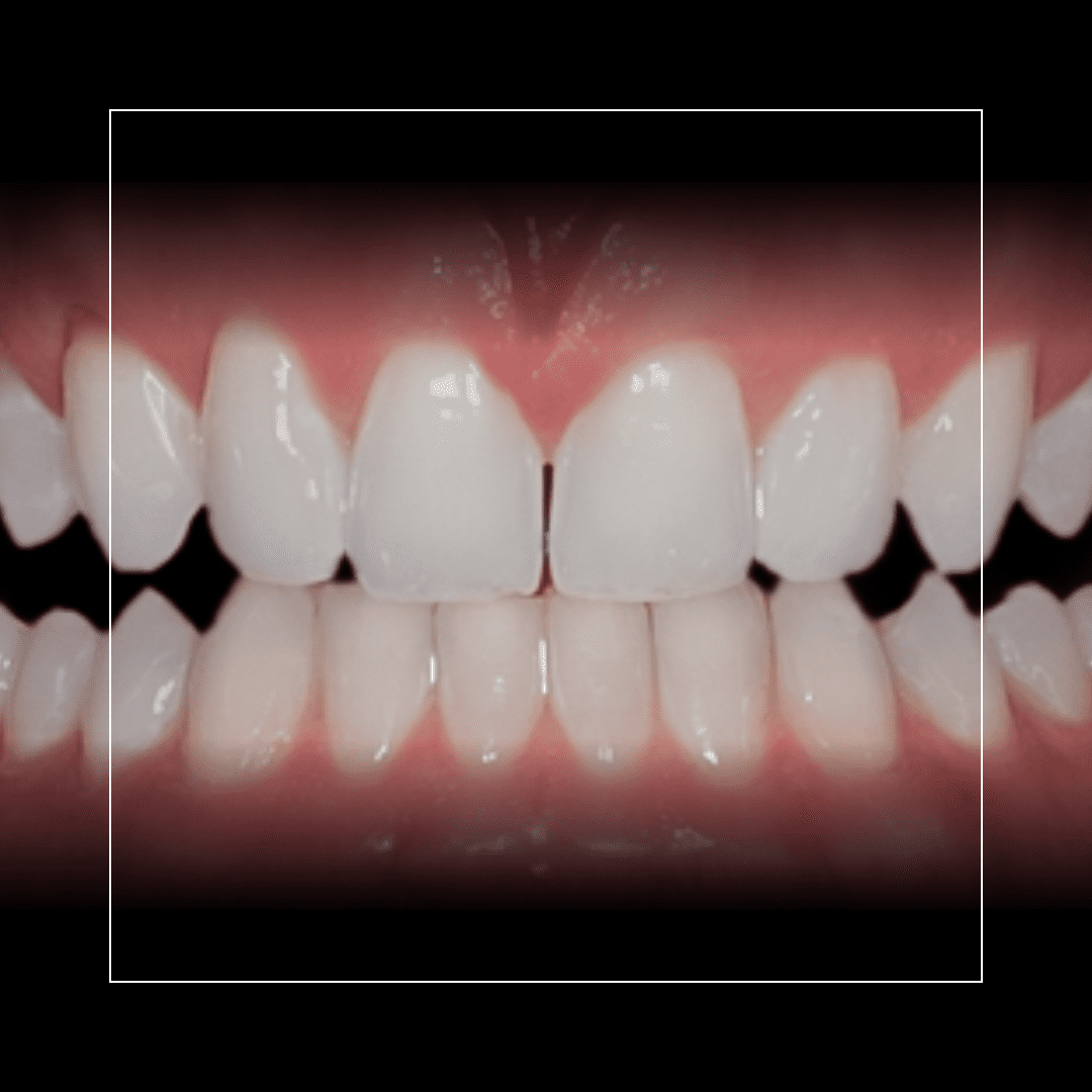 Wes – Invisalign for a Refined Look