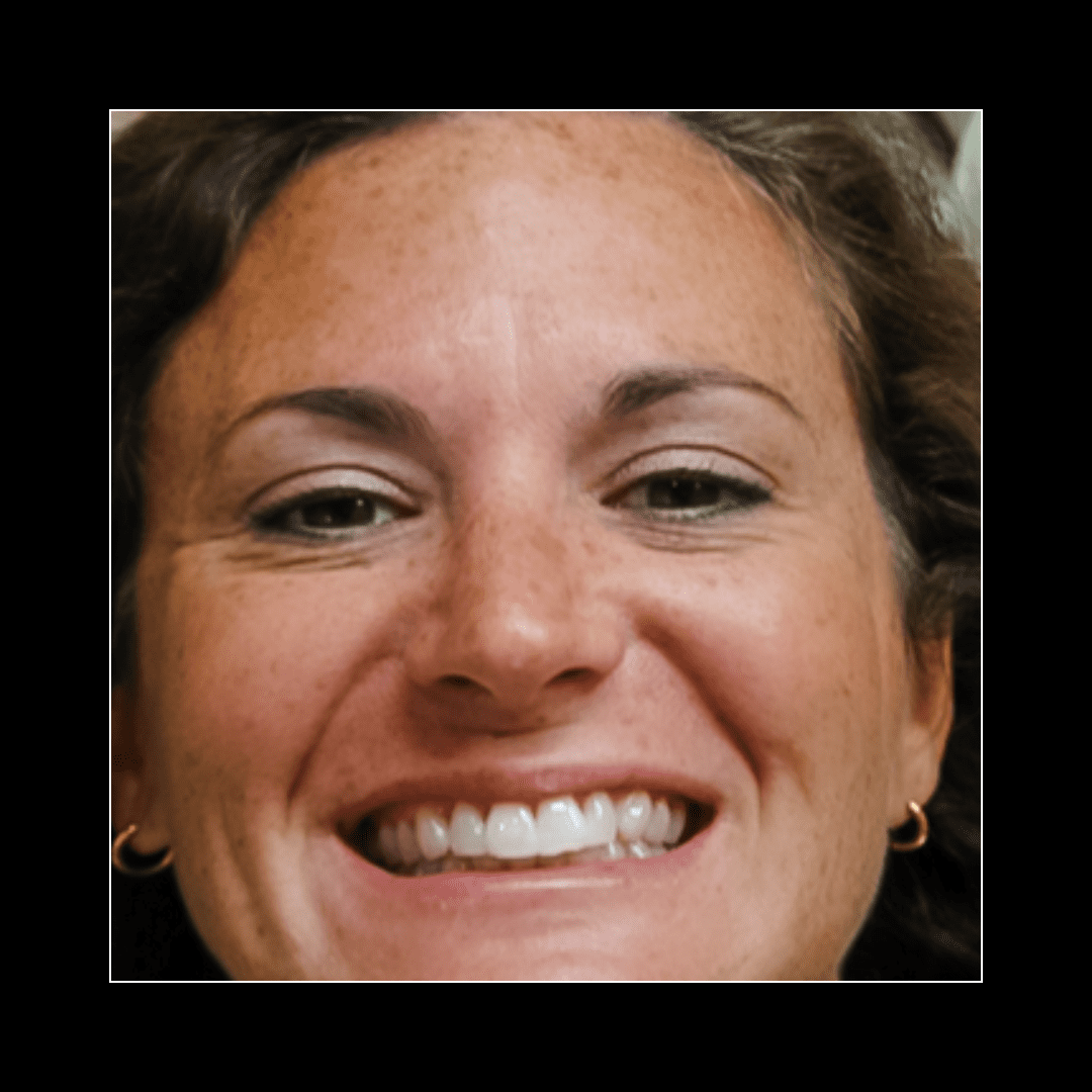 Zoom! 2 Tooth Whitening Subtle Results